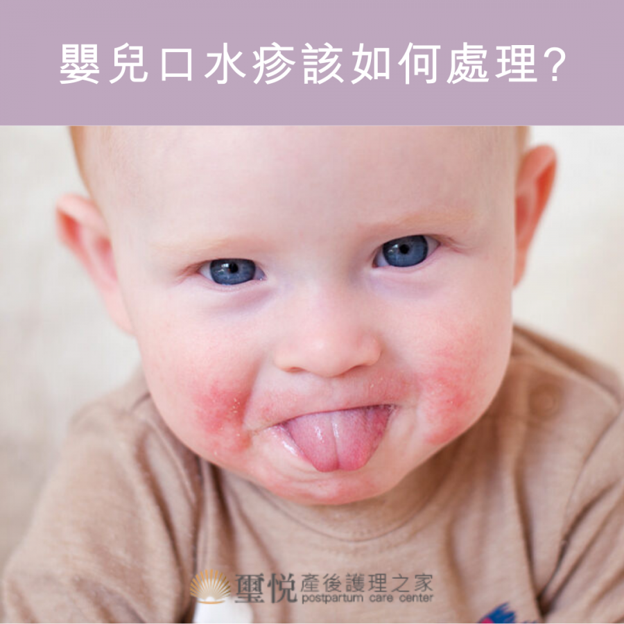 常見的嬰兒口水疹