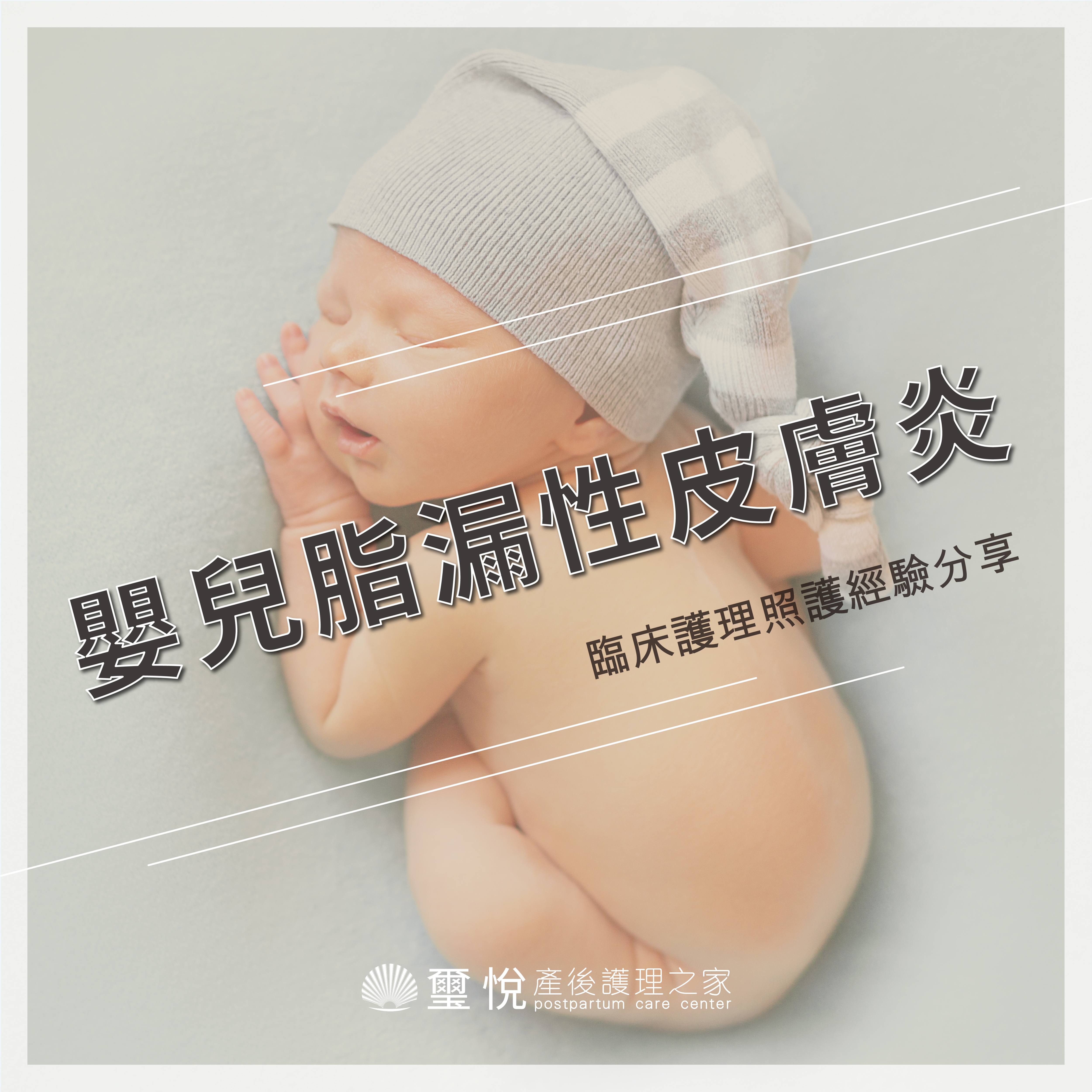 臨床護理照護經驗分享－嬰兒脂漏性皮膚炎