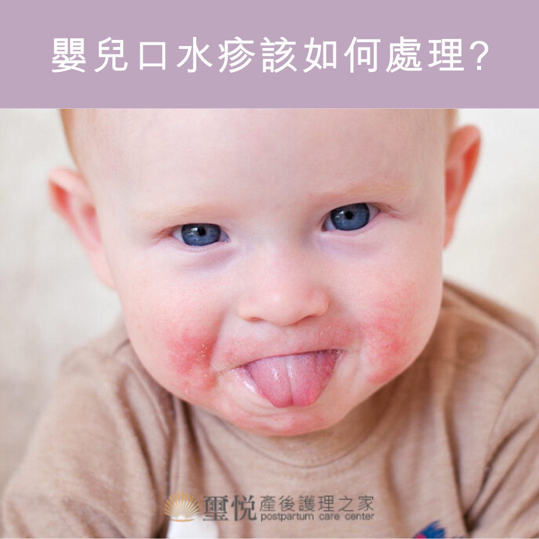 常見的嬰兒口水疹